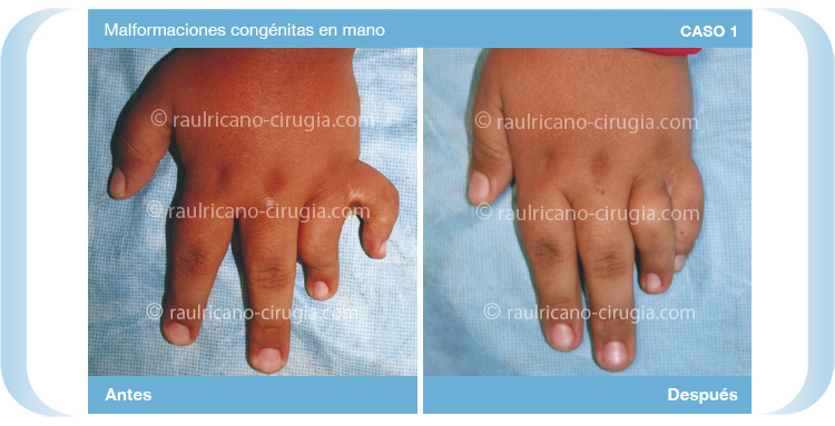 Reconstruccion  - Miembros Superiores manos - caso 1a, mejor cirujano plástico Puebla