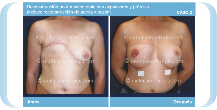 Reconstruccion - Senos, mamas - caso 2,  mamas, mejor cirujano plástico Puebla